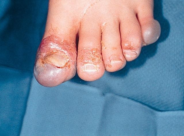 Frostbite Roenails frost-bite-toes | First Aid Courses Nelspruit